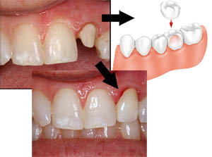 Dental Crowns