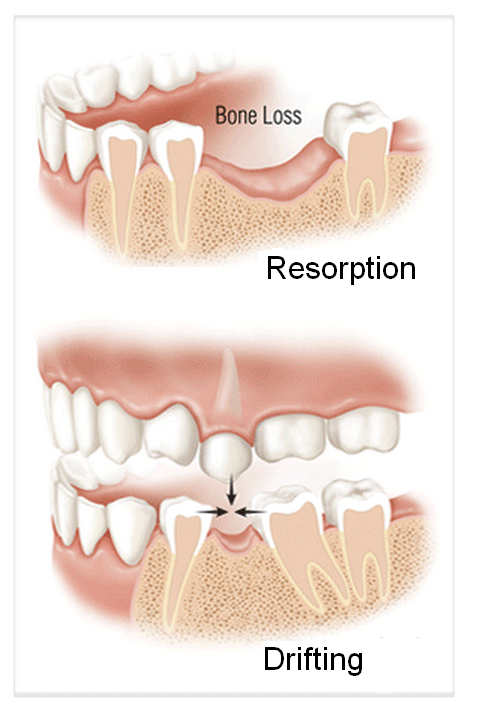 Drifting Teeth