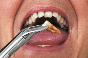 Painless Teeth Removal