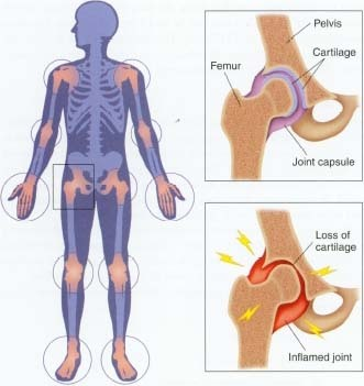 Osteoarthritis Image