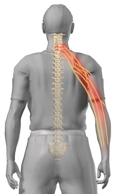 Radiculopathy Image