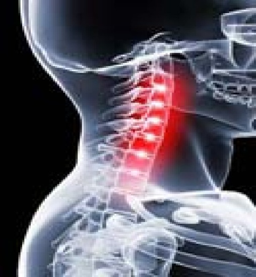 Spondylitis Image