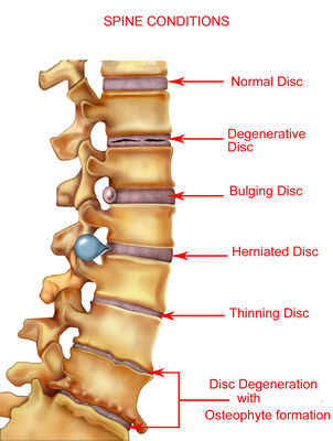 Spondylosis Image