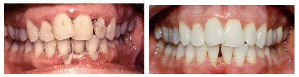 Cleaning of Teeth