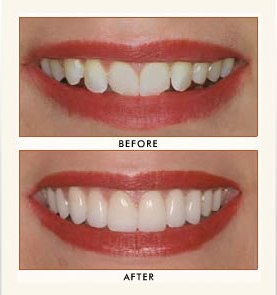 Veneers